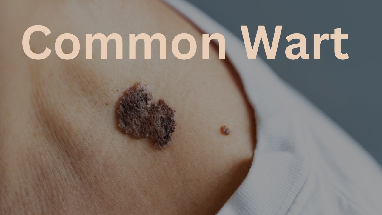 Home Remedy Common Wart on Finger