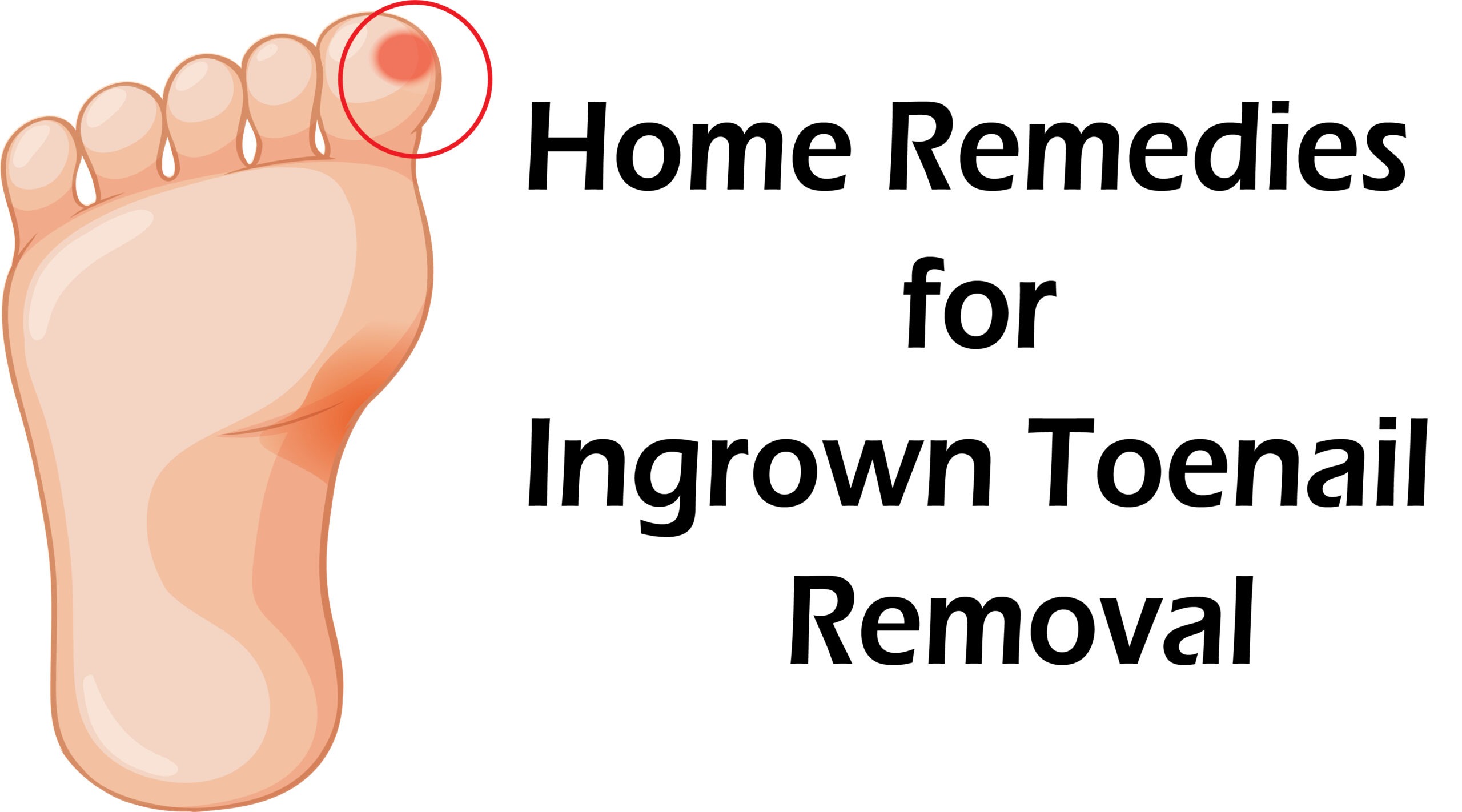Home Remedies for Ingrown Toenail Removal